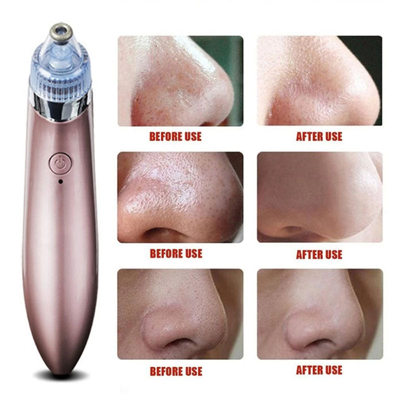 Portable Electric Blackhead Remover